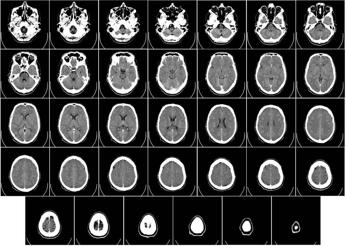 Your 3-Pound Brain Burns 20% of Your Calories